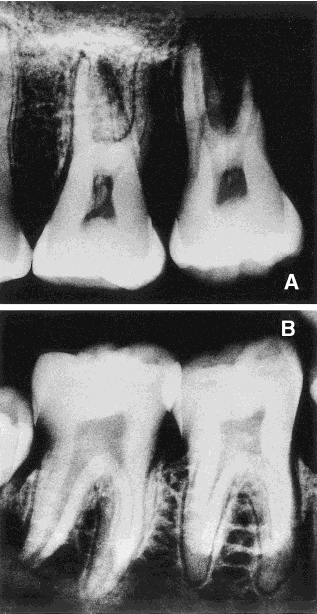 Broadbech taurodont molars